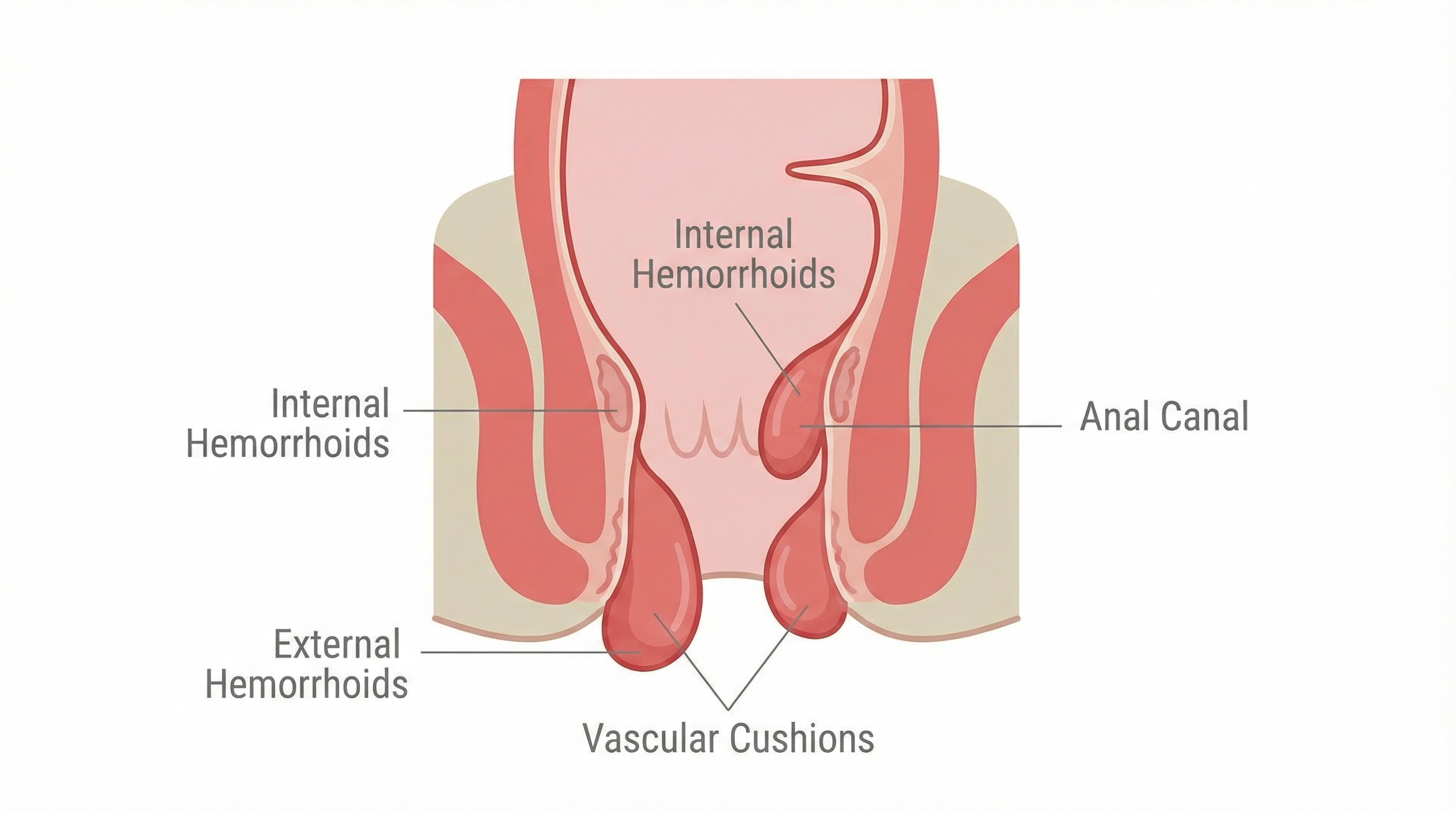 Medical illustration of Piles Surgery