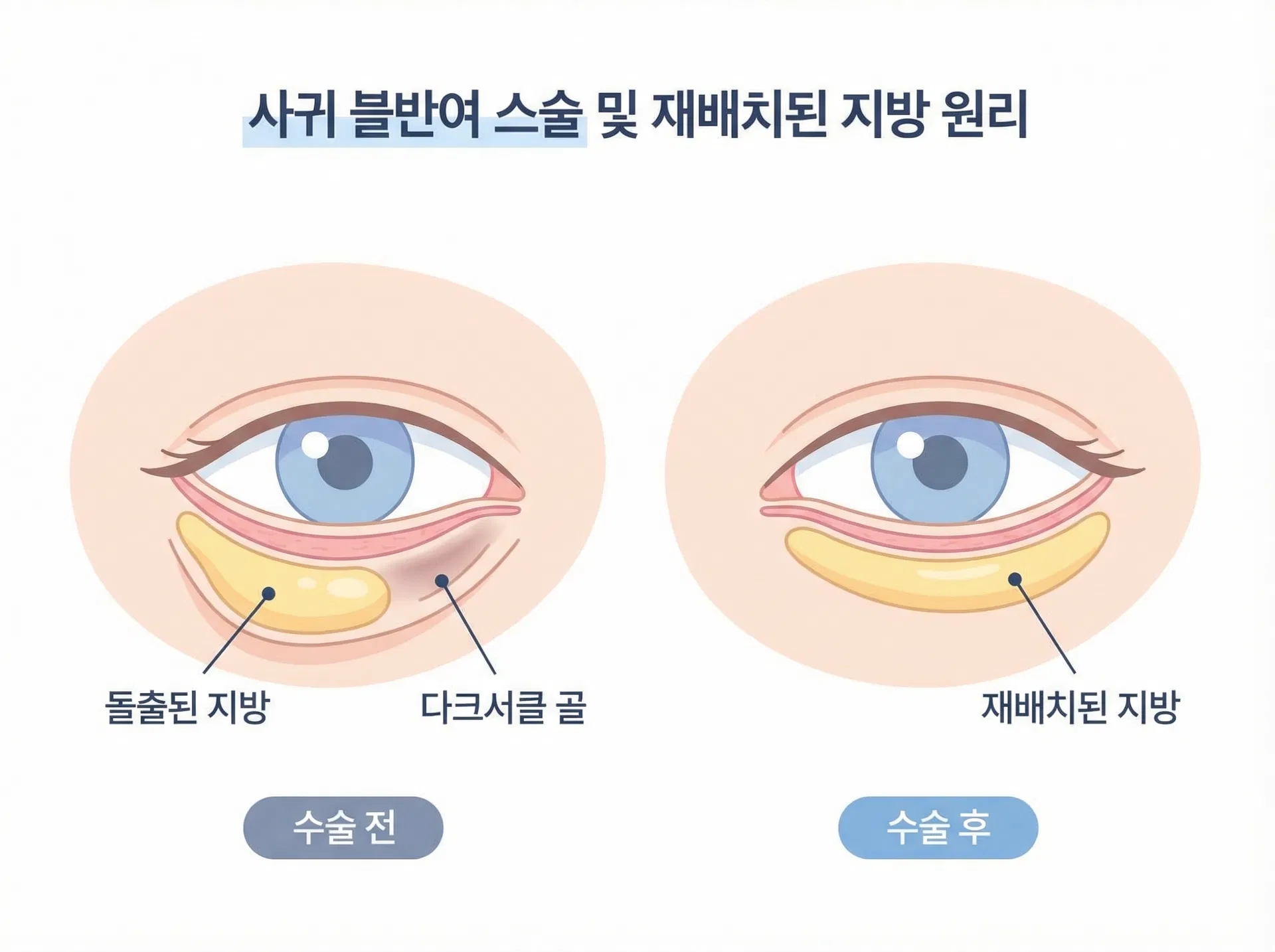 에디션성형외과 눈밑지방재배치