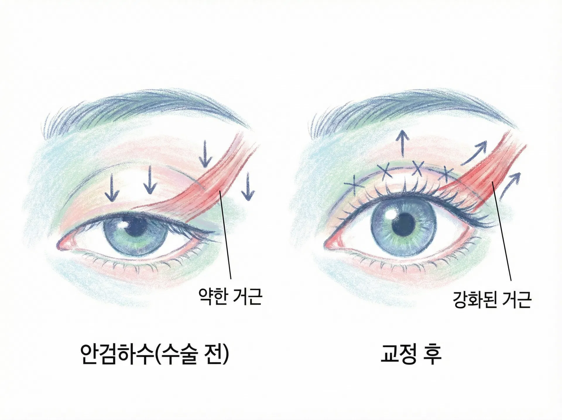 에디션성형외과 눈 재수술