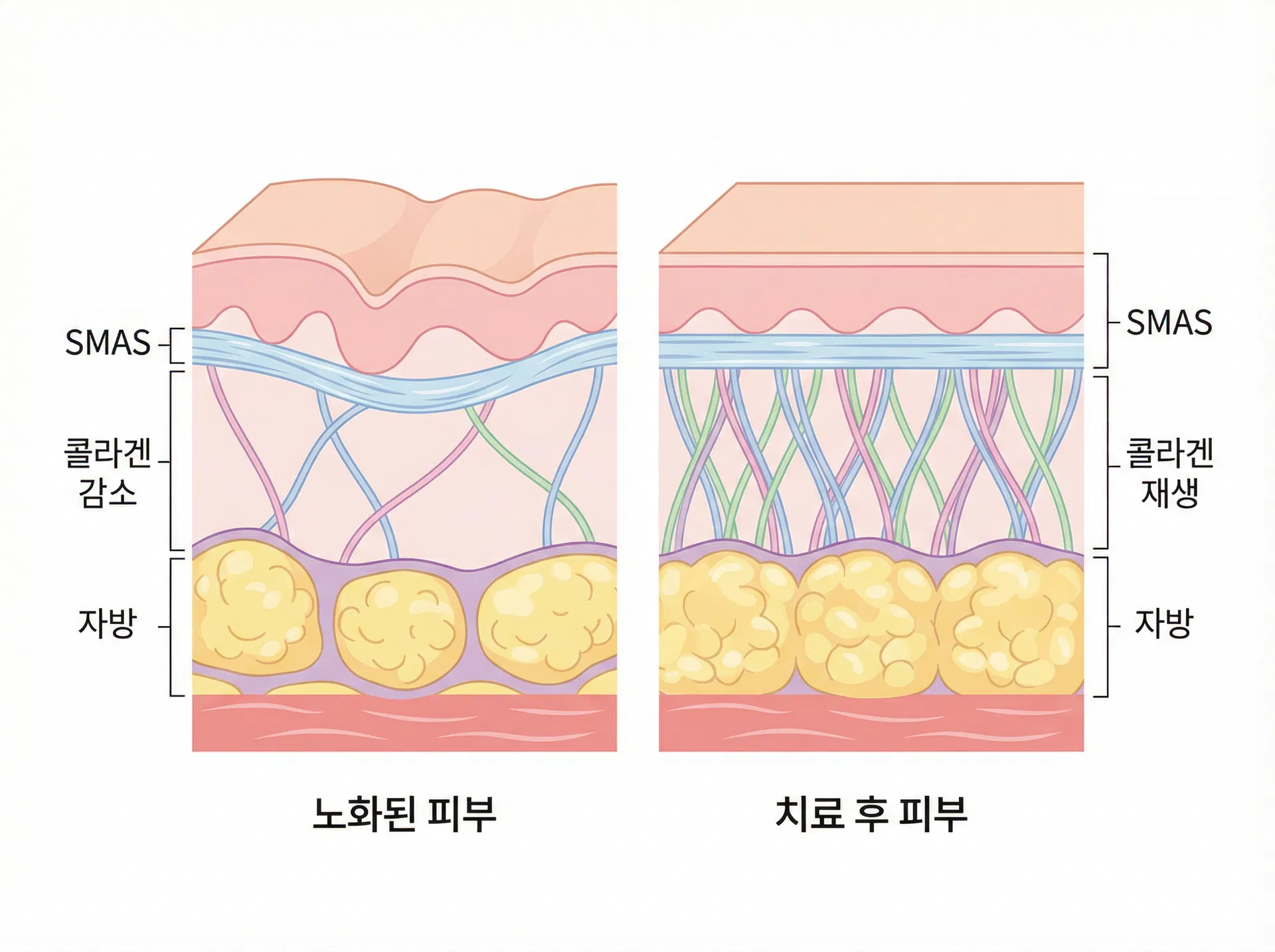 에디션성형외과 울쎄라