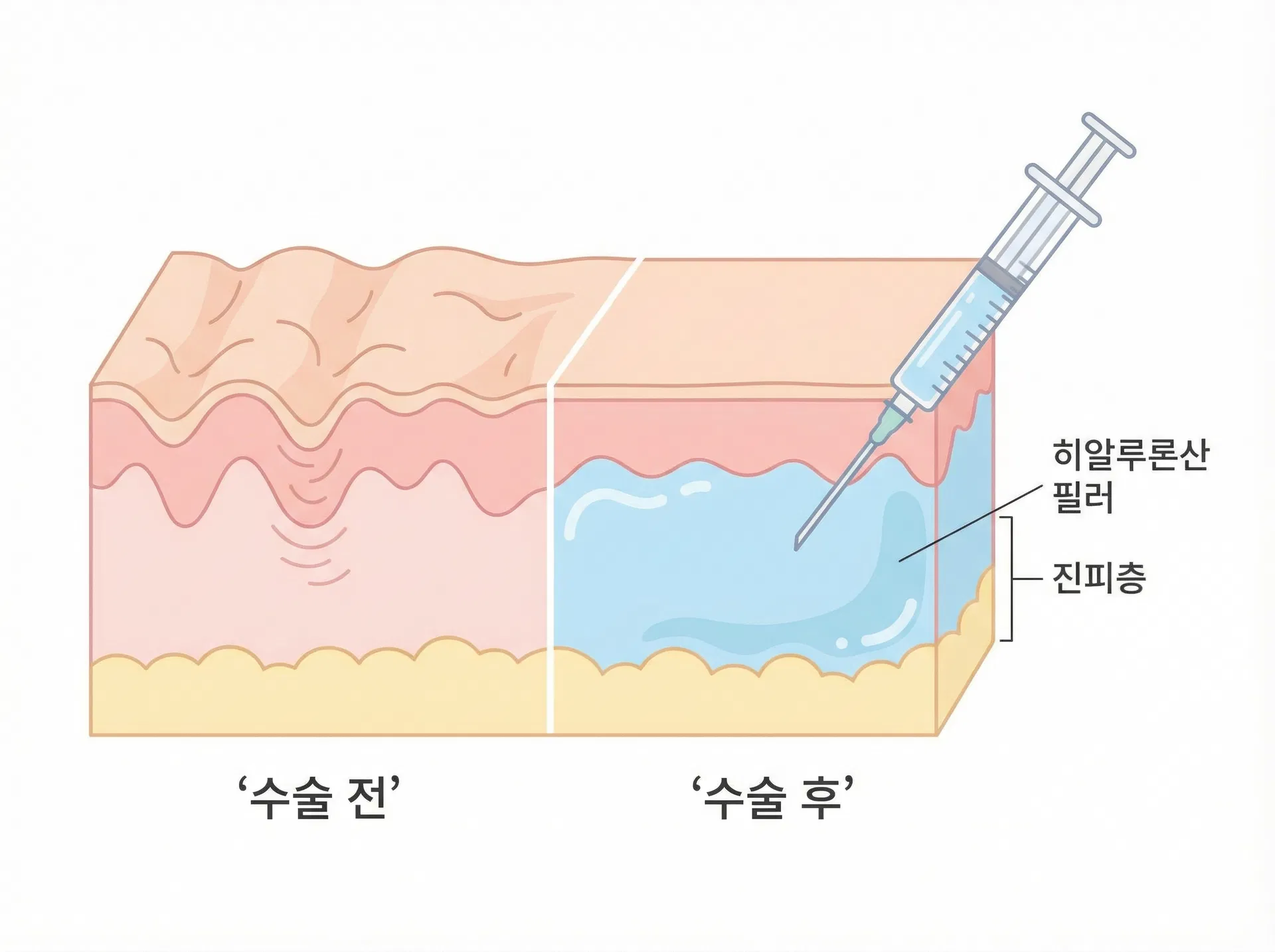 에디션성형외과 스킨부스터