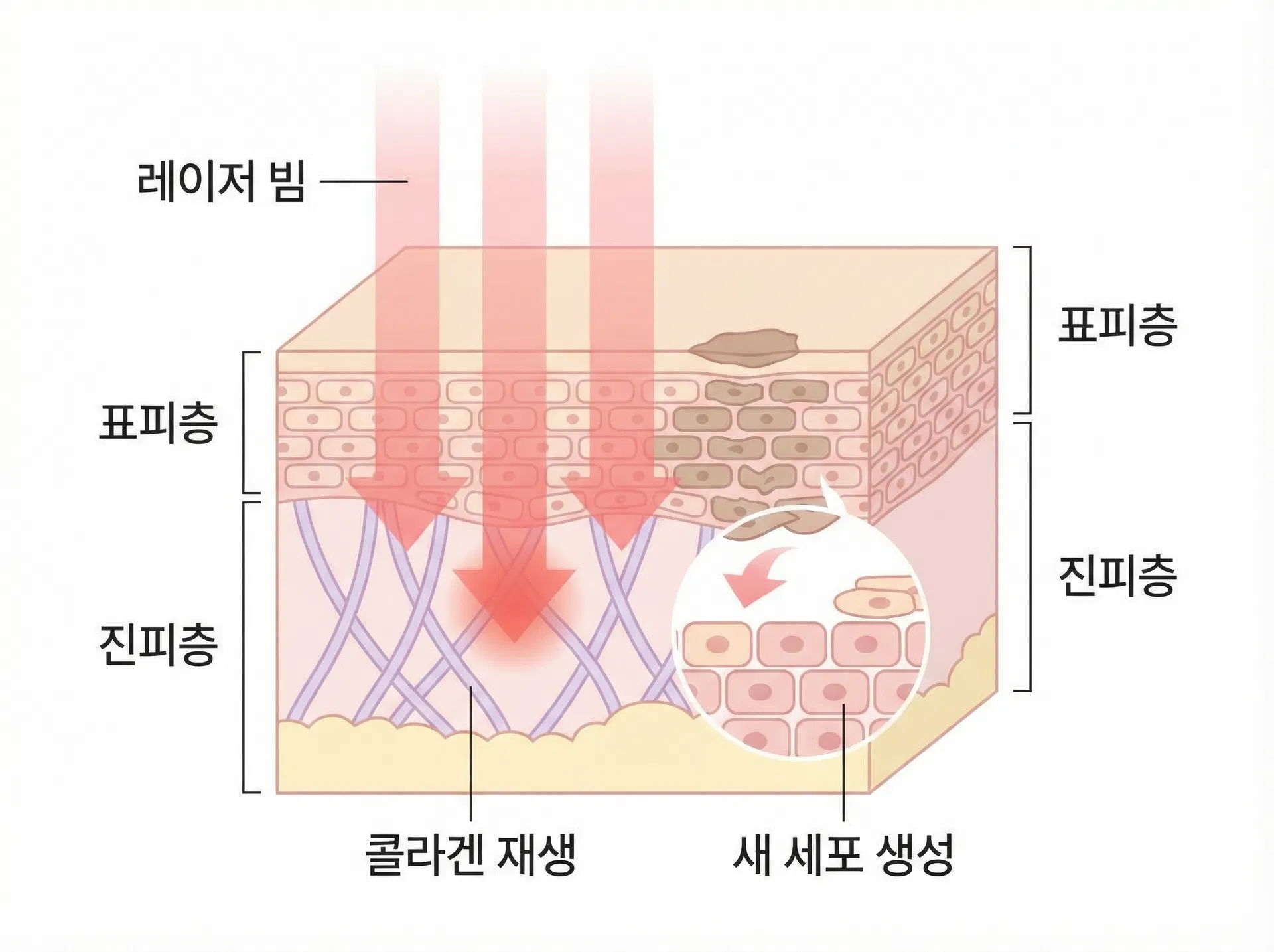 에디션성형외과 레이저 시술