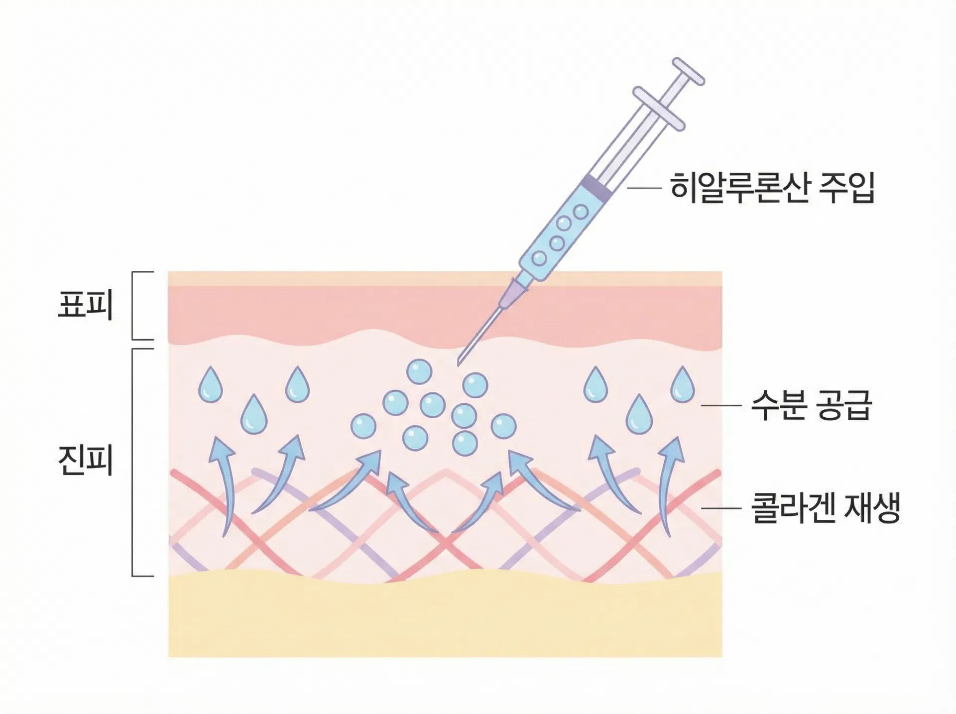 에디션성형외과 스킨부스터