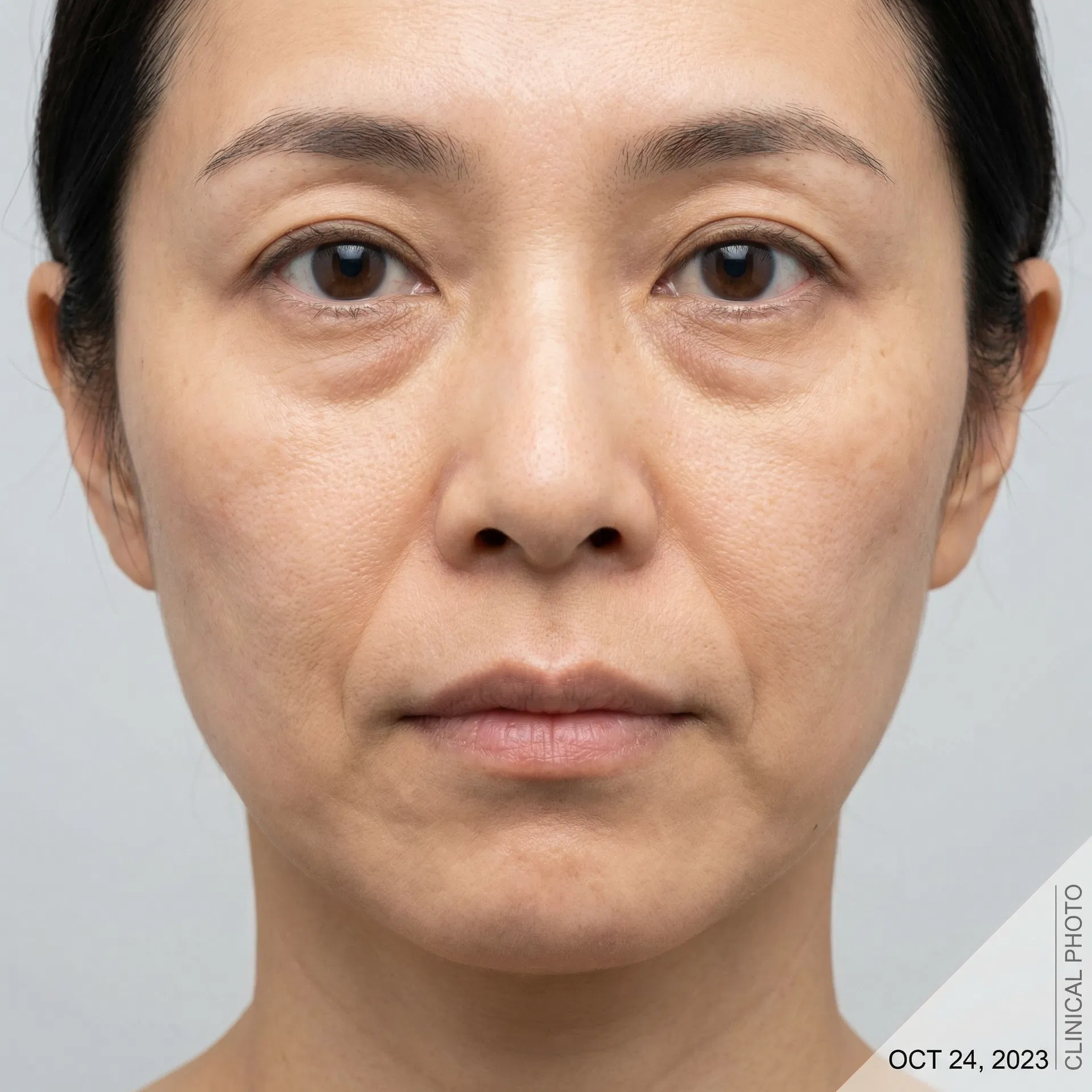 ほうれい線・目の下のくぼみ改善 Before