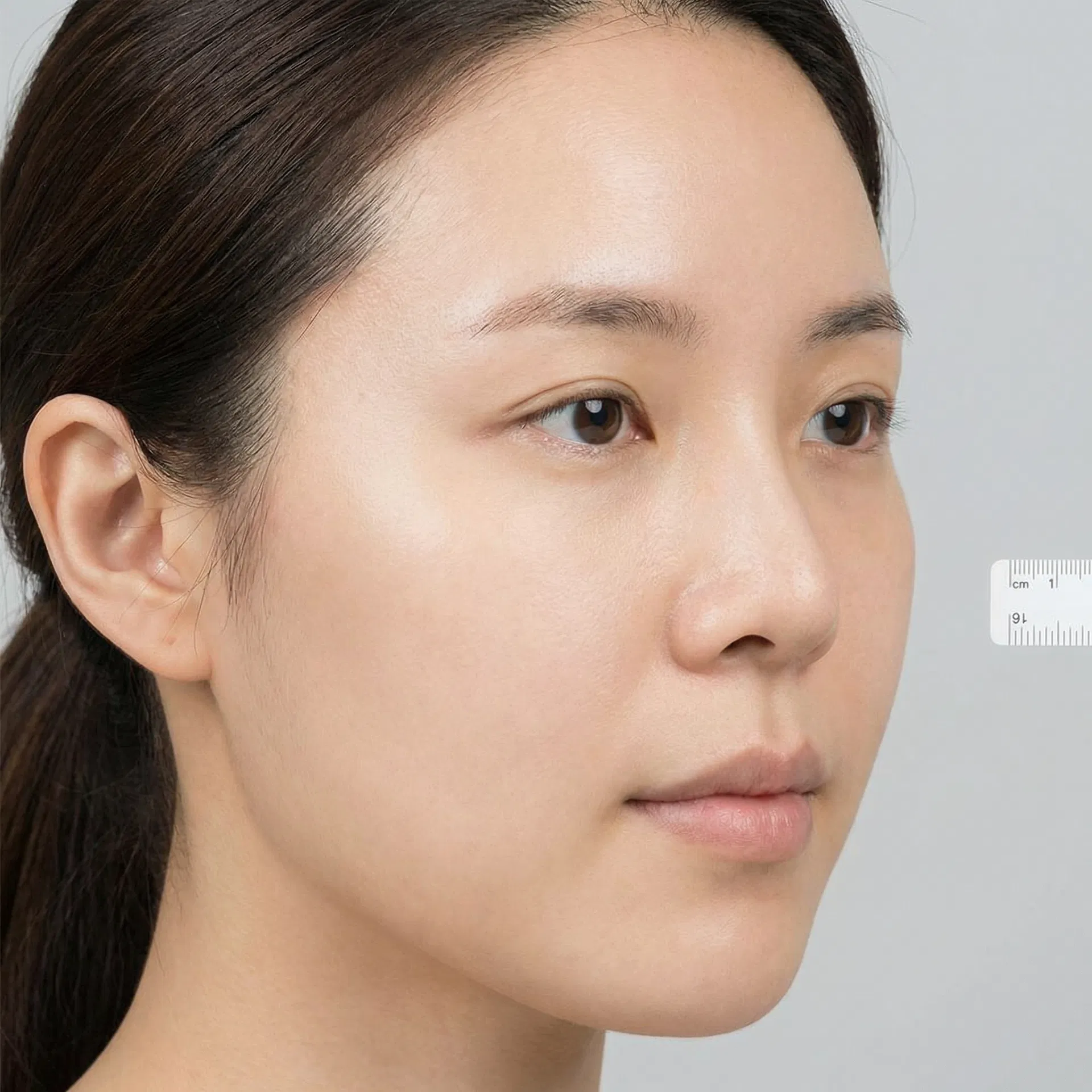 しみ・色素沈着の改善 After