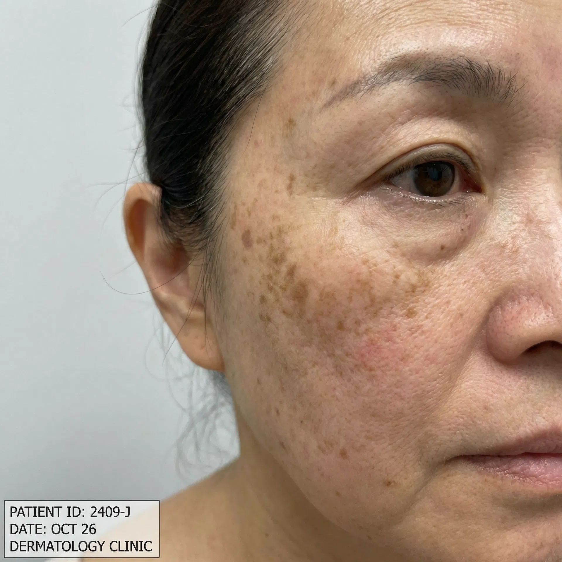 しみ・色素沈着の改善 Before