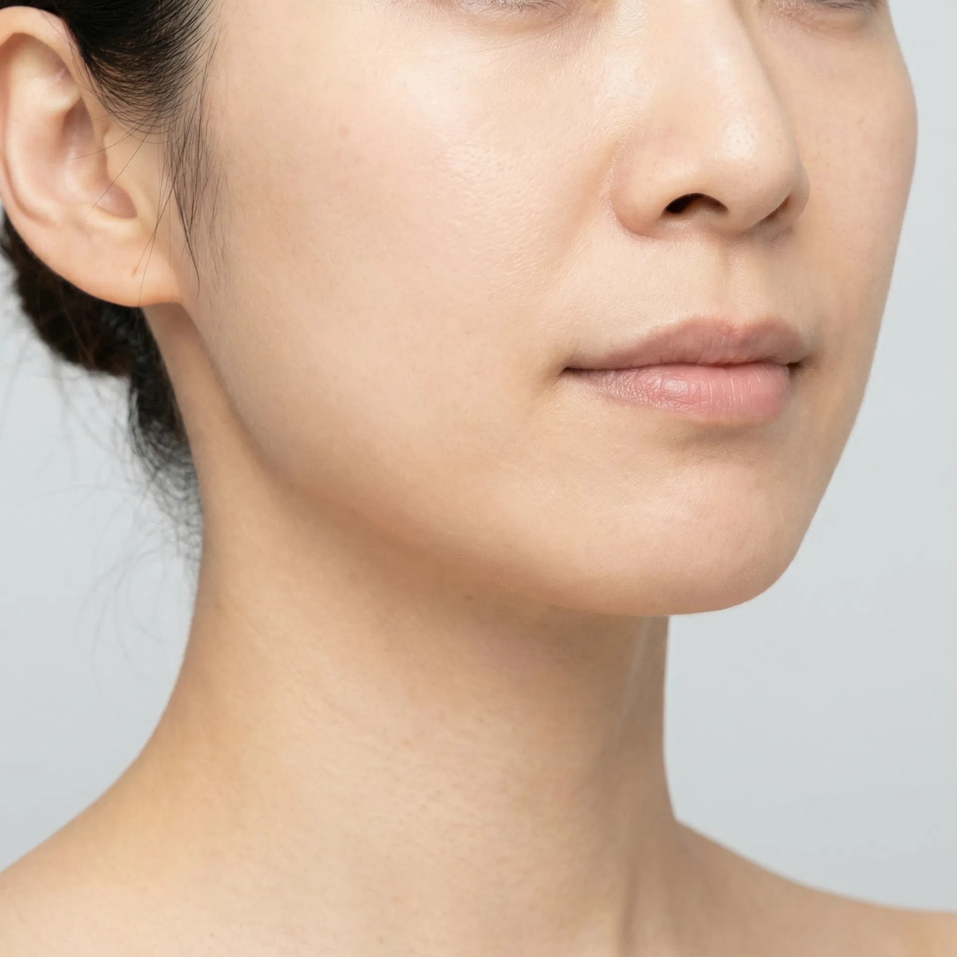 フェイスライン引き締め・たるみ改善 After