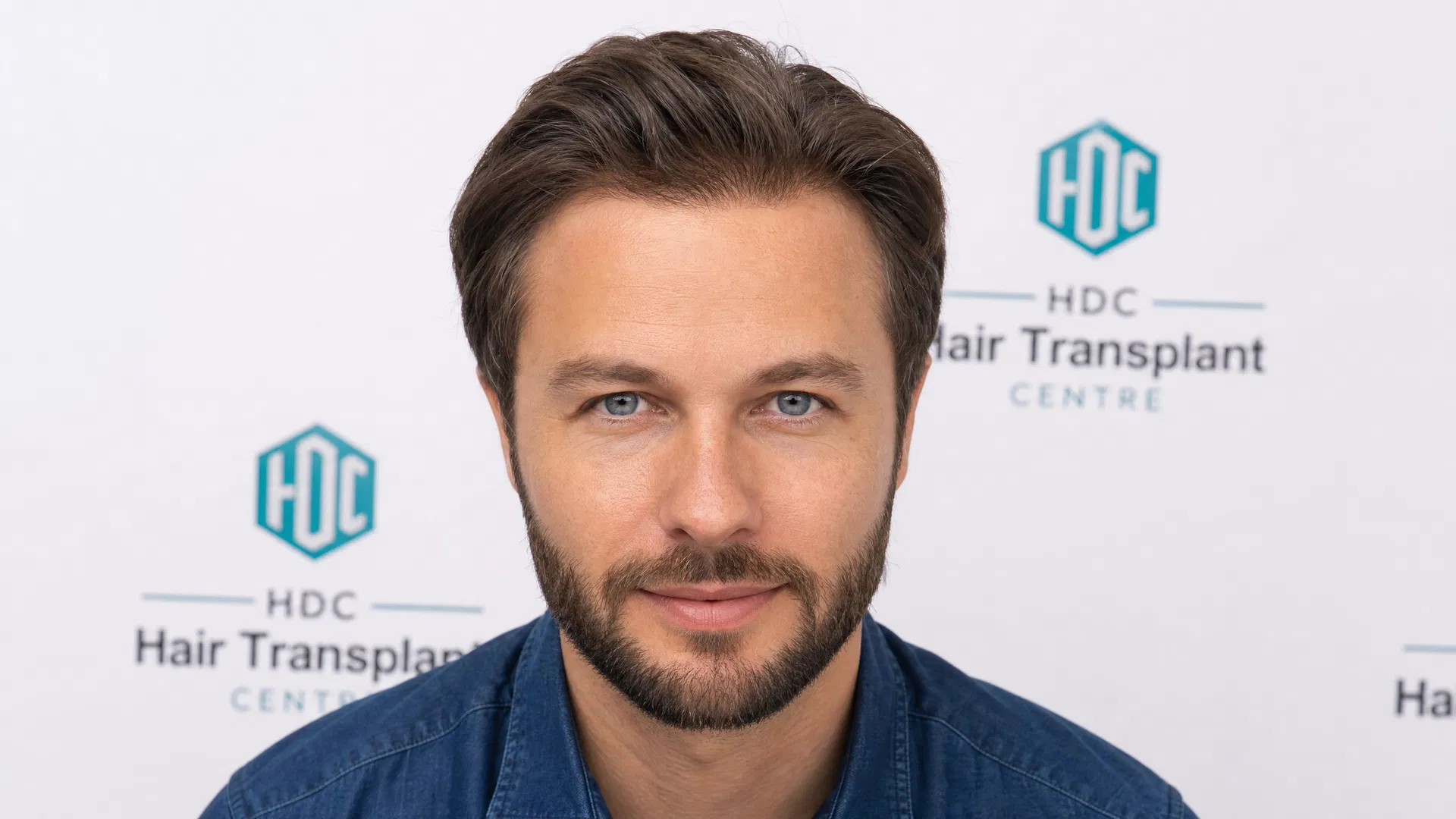 Side-by-side before and after photos showing FUE hair transplant results at 12 months