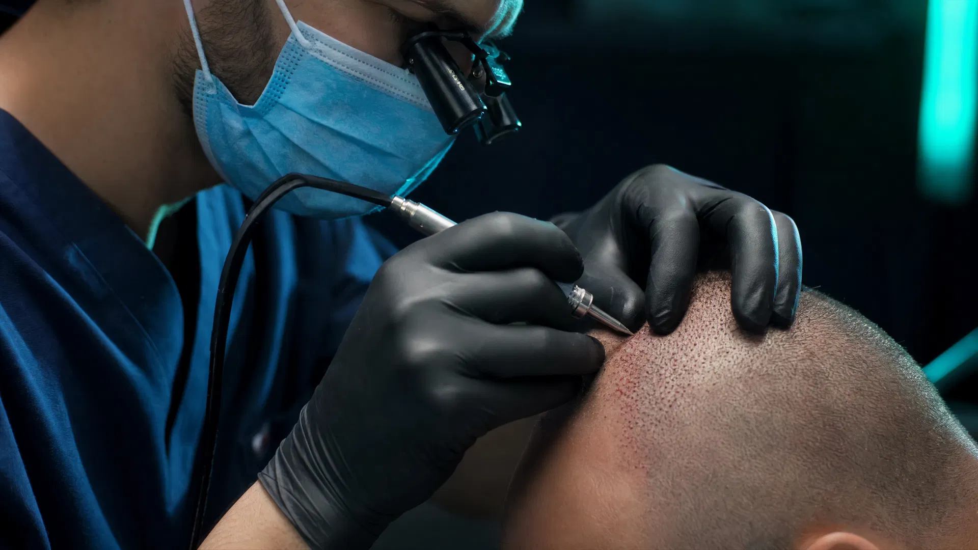 Close-up of a hair transplant specialist performing an FUE procedure