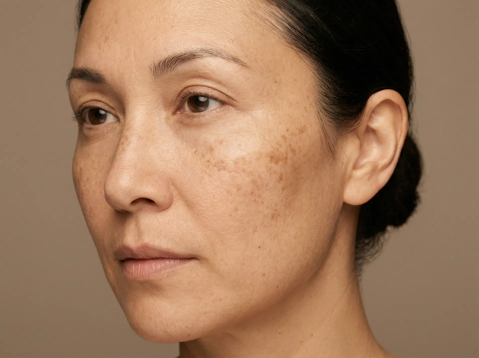 Before laser pigmentation reduction