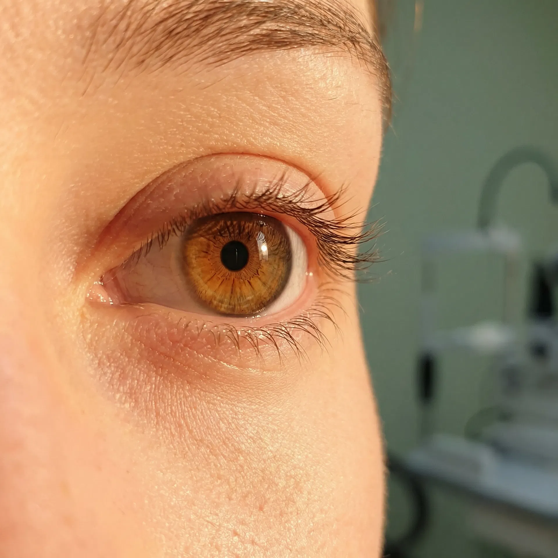 Nærbilde av øye etter nedre øyelokksoperasjon