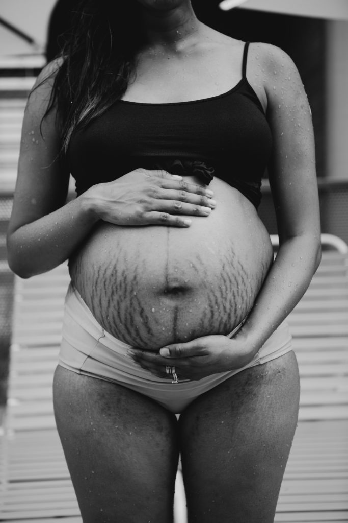 Stretch Marks on Indian Women