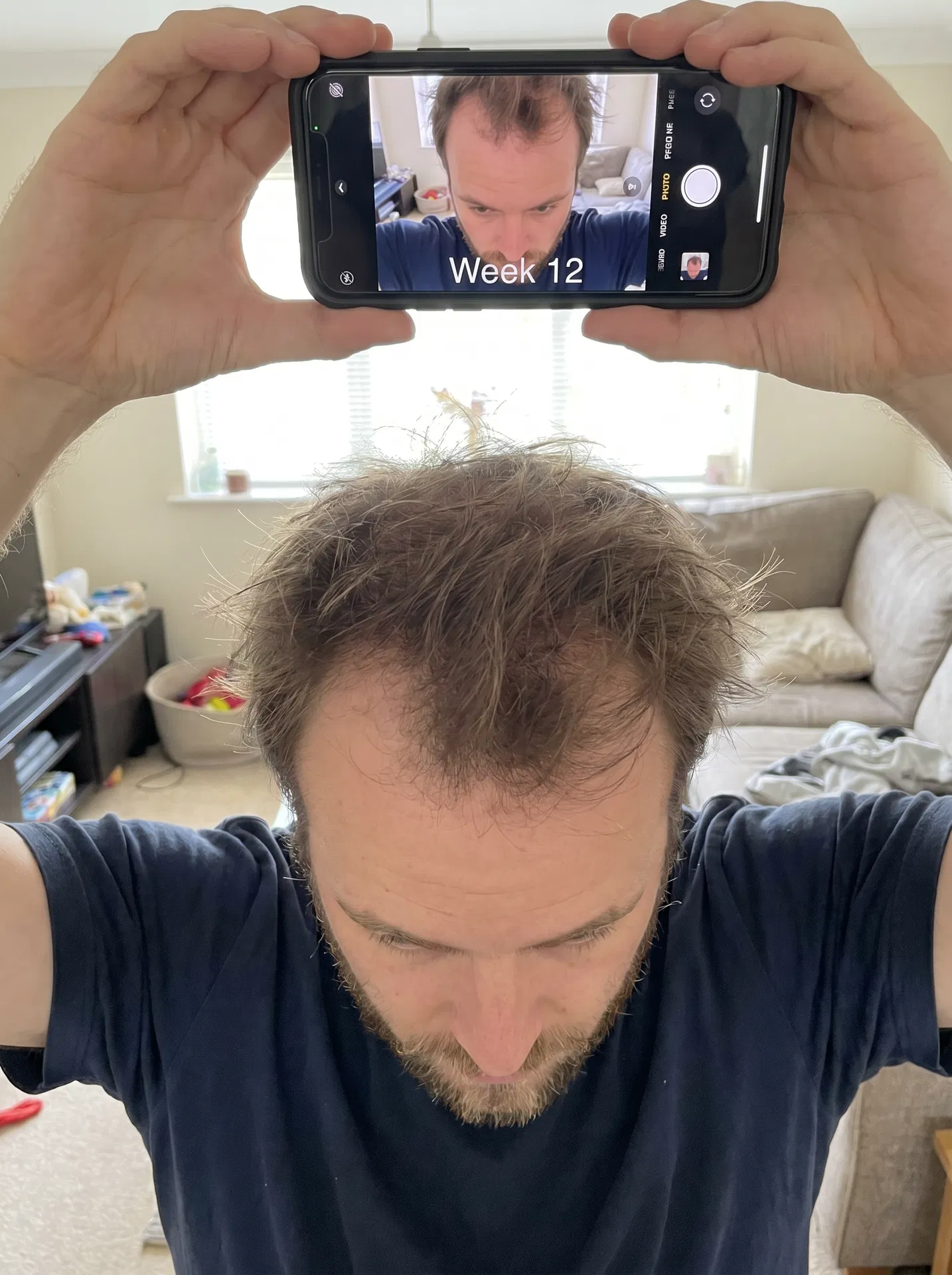 Nach 12 Wochen – Draufsicht-Selfie, leicht dichtere Haare