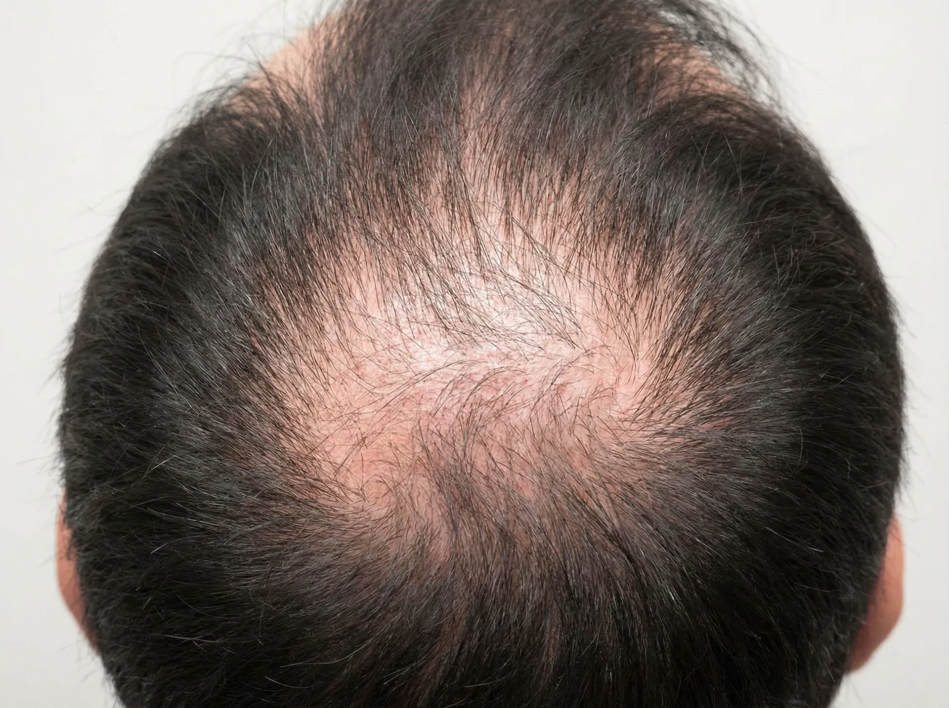 Breiter werdender Scheitel