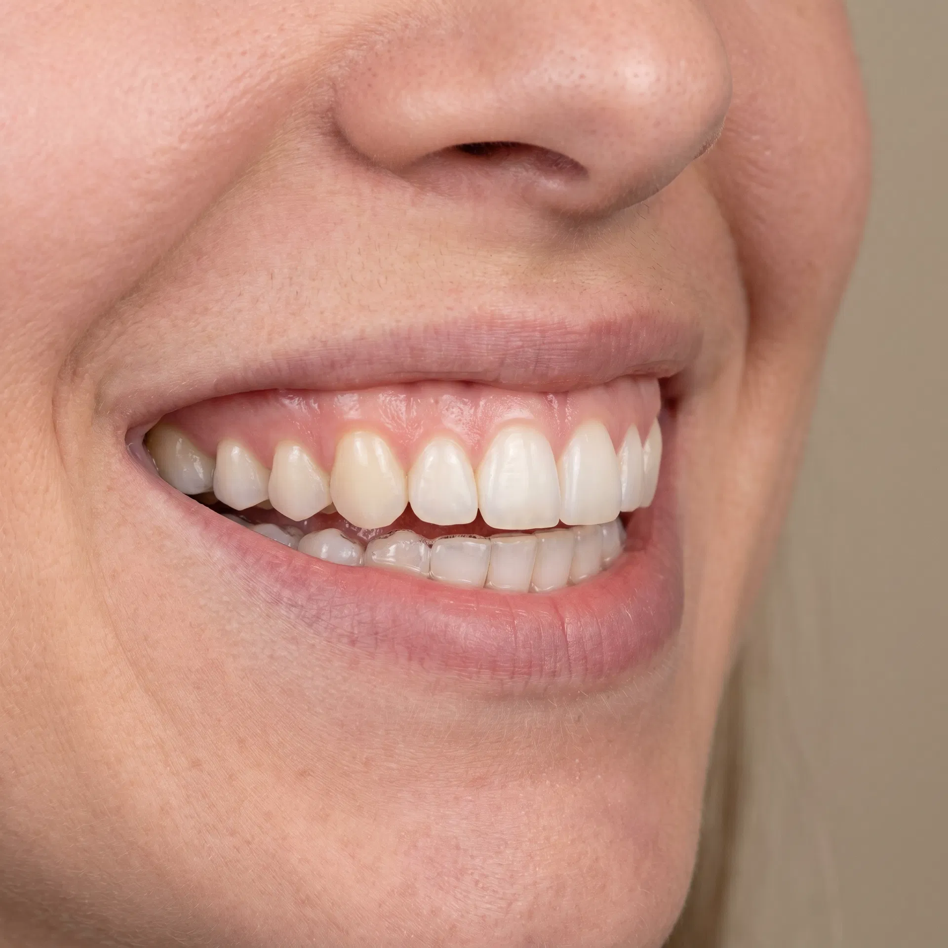 Dentes perfeitamente alinhados após tratamento ortodôntico com aparelho dentário em Peruíbe-SP