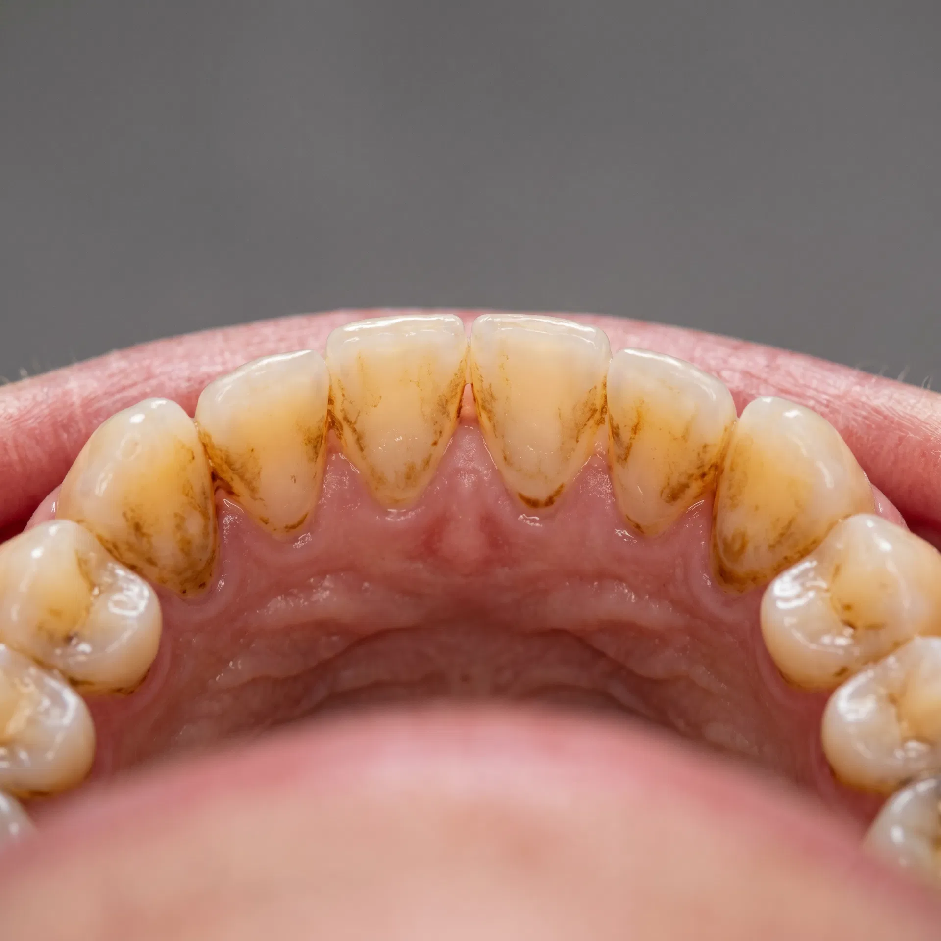 Dentes amarelados e manchados antes do clareamento dental em Peruíbe-SP