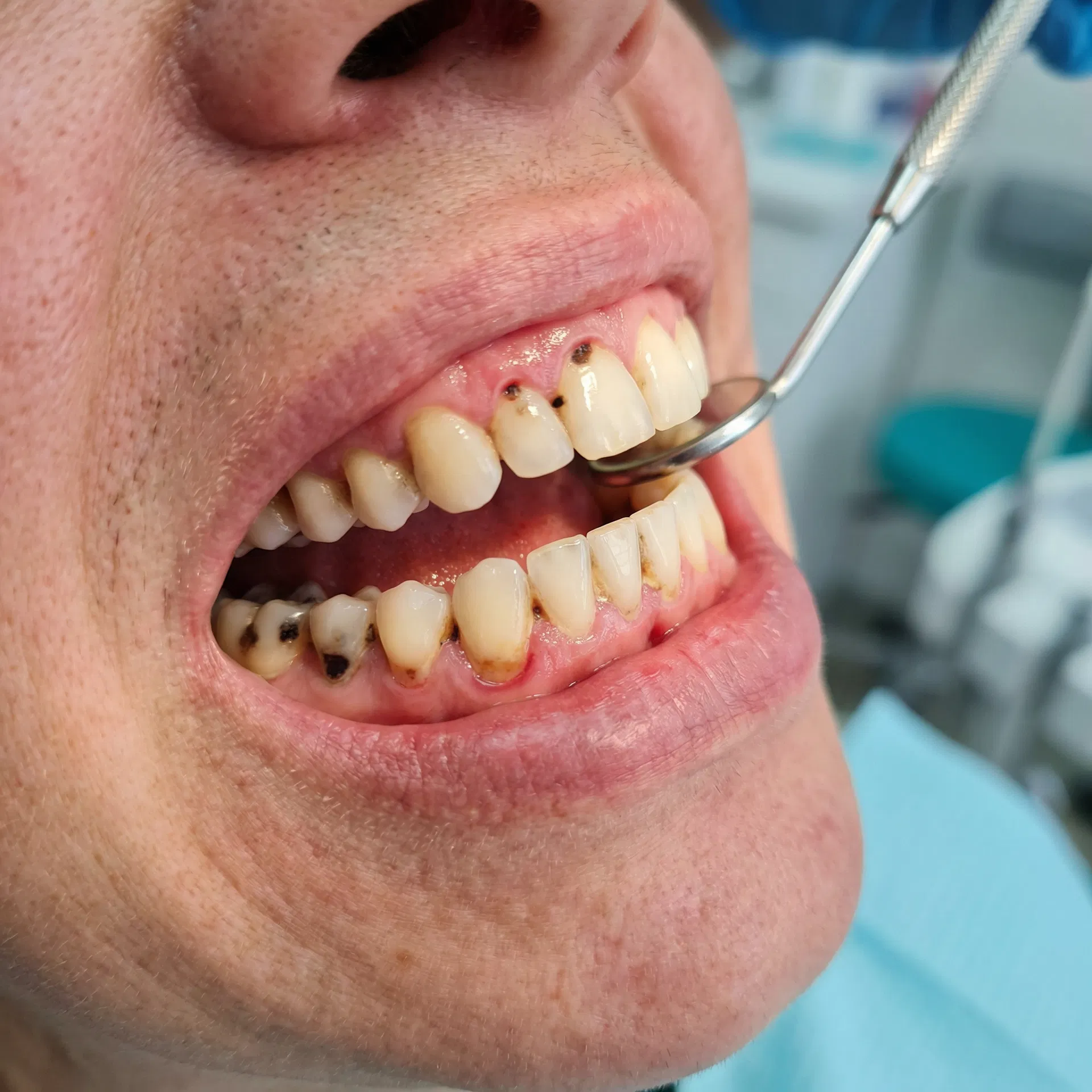 Antes do tratamento de Clínico Geral em Peruíbe-SP