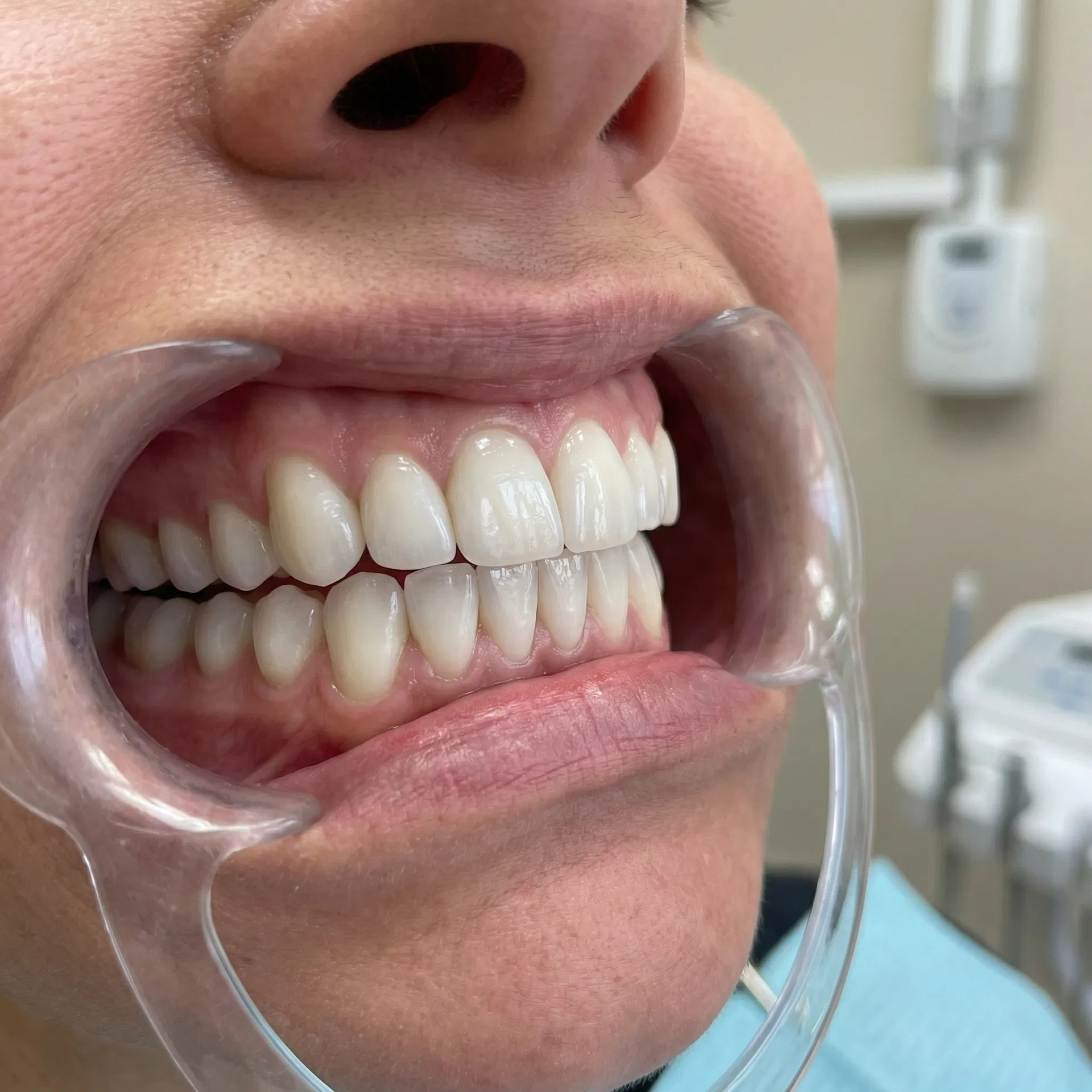 Depois do tratamento de Estética Dental em Peruíbe-SP