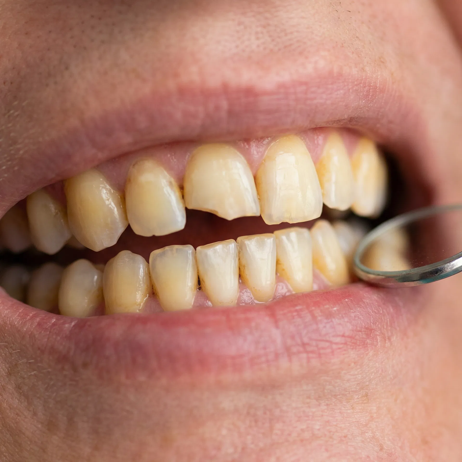 Antes do tratamento de Estética Dental em Peruíbe-SP