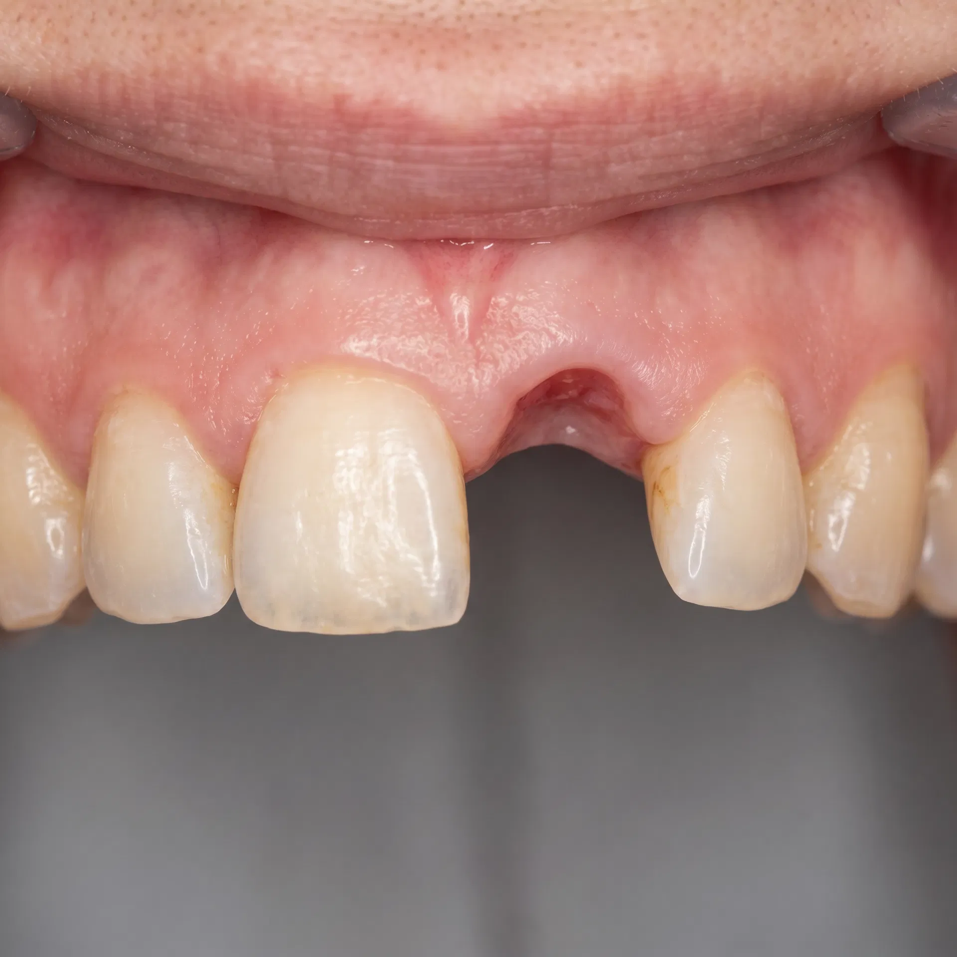 Espaço vazio por dente perdido antes da colocação de implante dentário em Peruíbe-SP