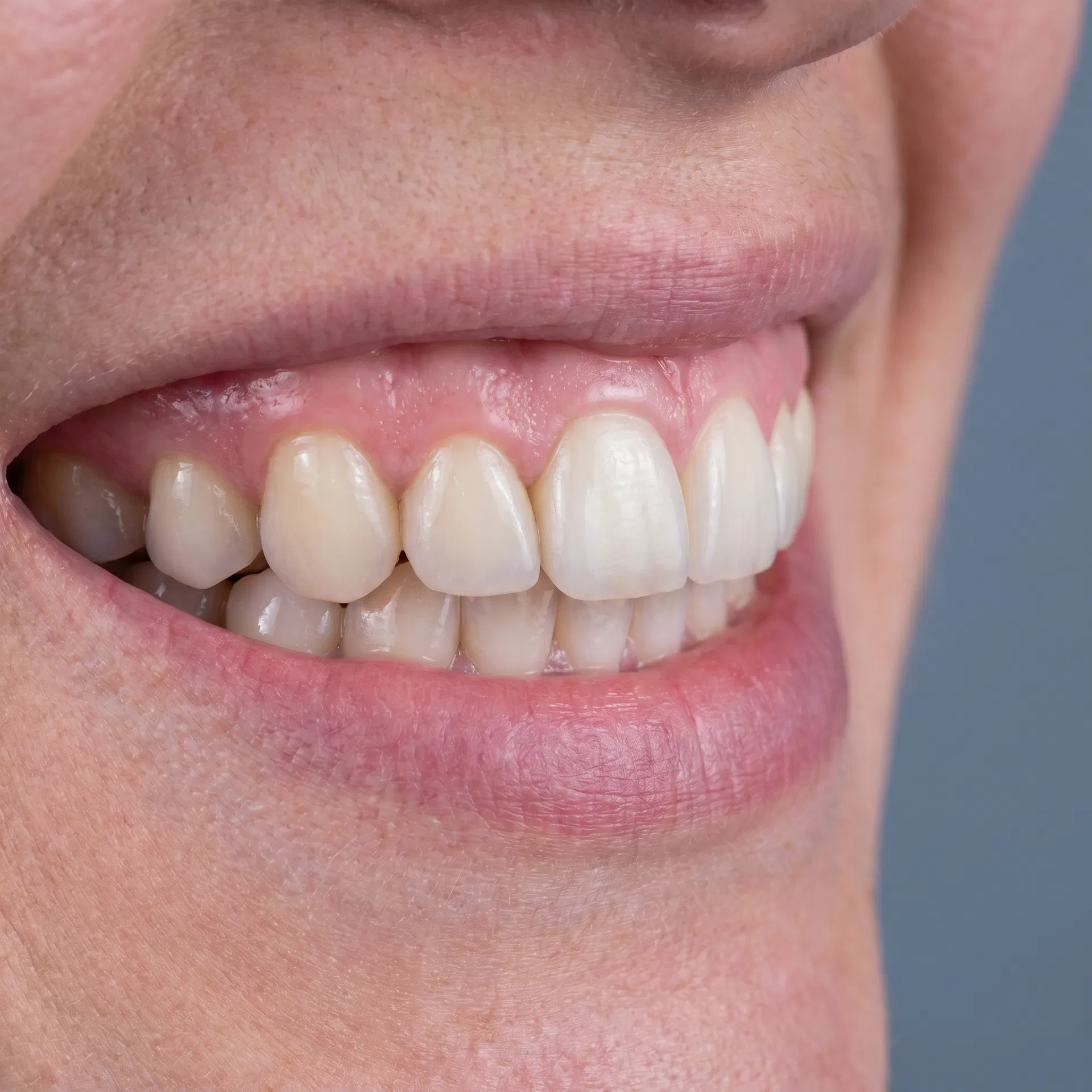 Implante dentário colocado com coroa ceramética natural após tratamento em Peruíbe-SP