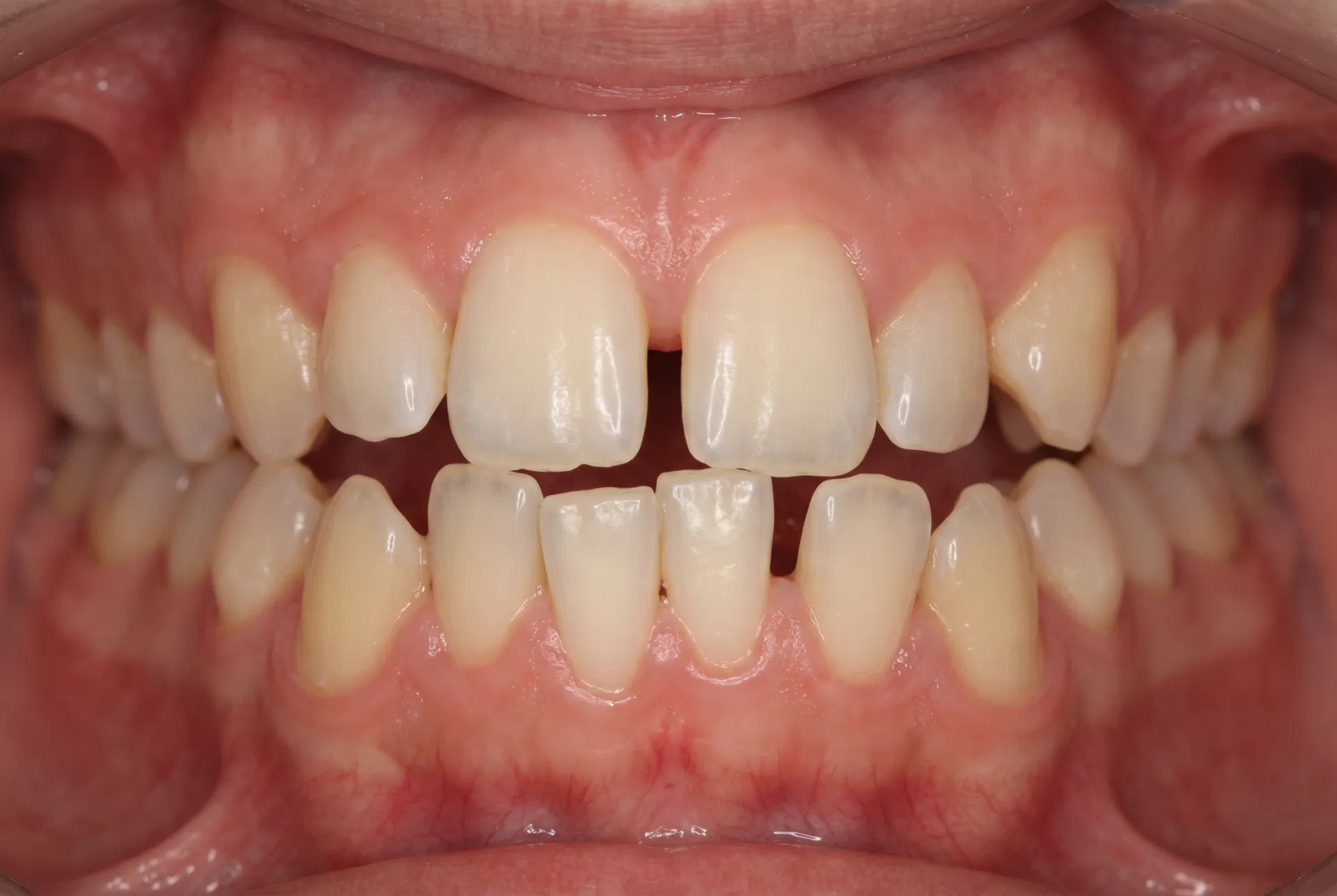 Apinhamento dentário severo antes do uso de aparelho ortodôntico em Peruíbe