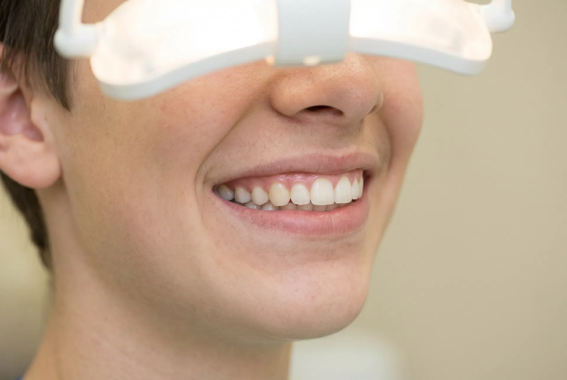 Sorriso alinhado e harmonioso após ortodontia com aparelho dentário em Peruíbe-SP