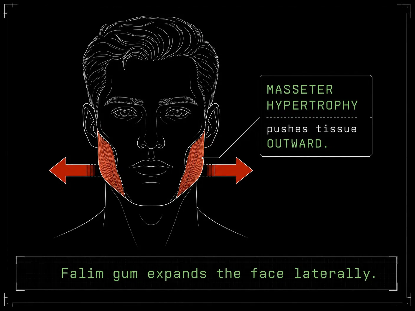 Masseter hypertrophy — before and after