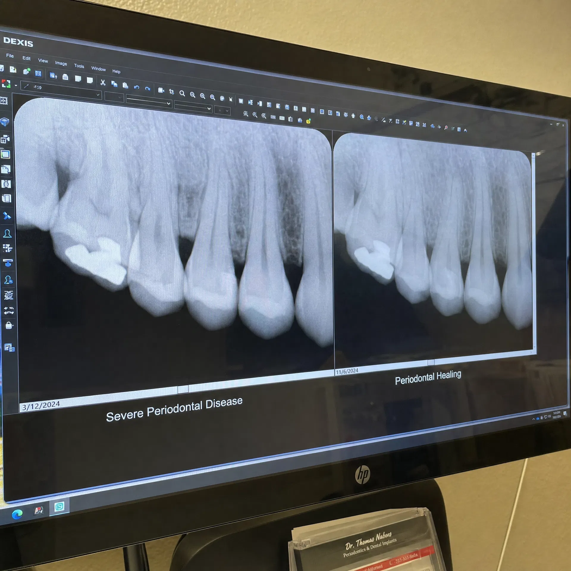 Before and after X-ray: Marcus K.
