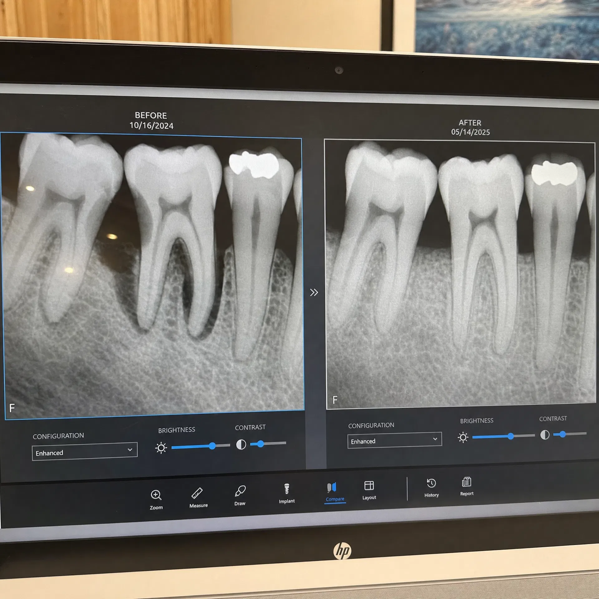 Before and after X-ray: David L.