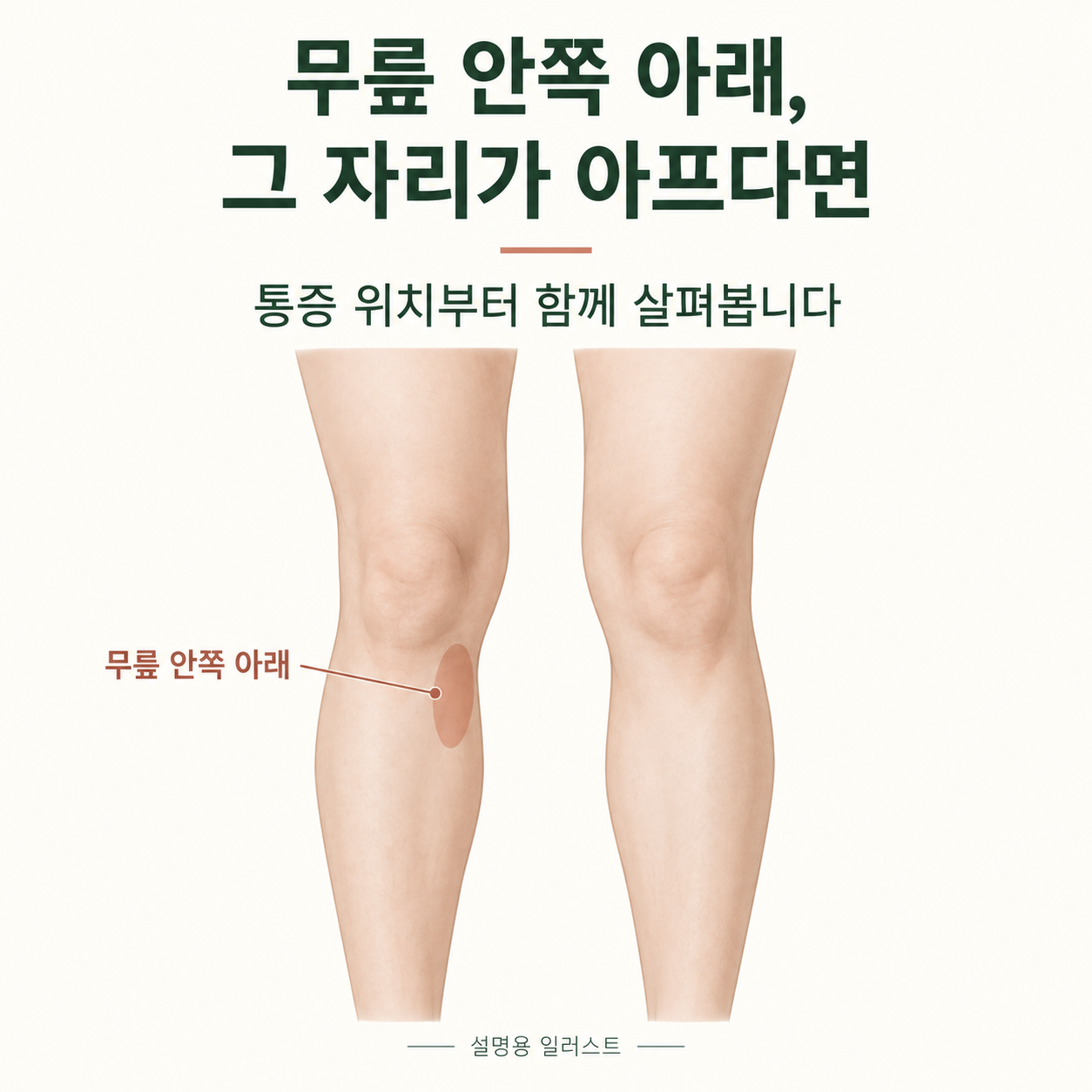 무릎 안쪽 아래의 통증 위치 · 설명용 일러스트