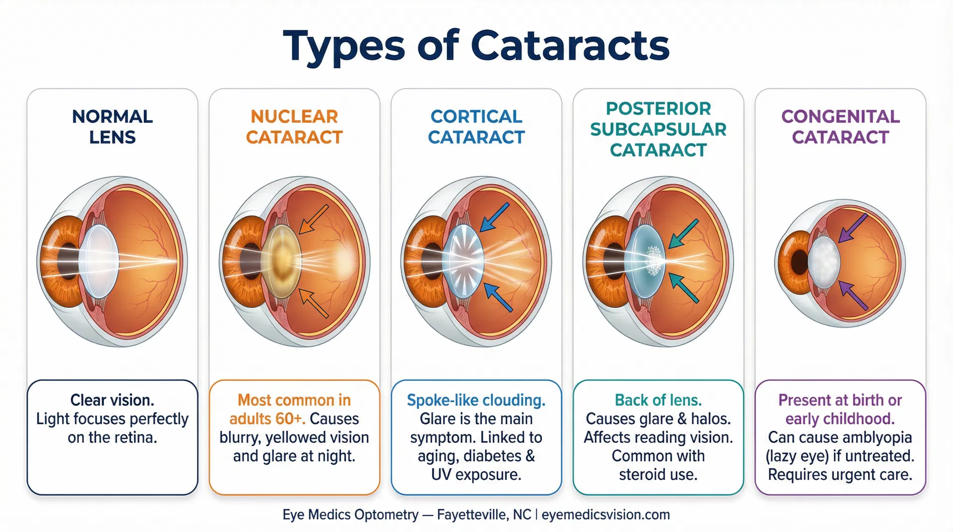 Educational diagram showing 5 types of cataracts: normal lens, nuclear cataract, cortical cataract, posterior subcapsular cataract, and congenital cataract — Eye Medics Optometry Fayetteville NC