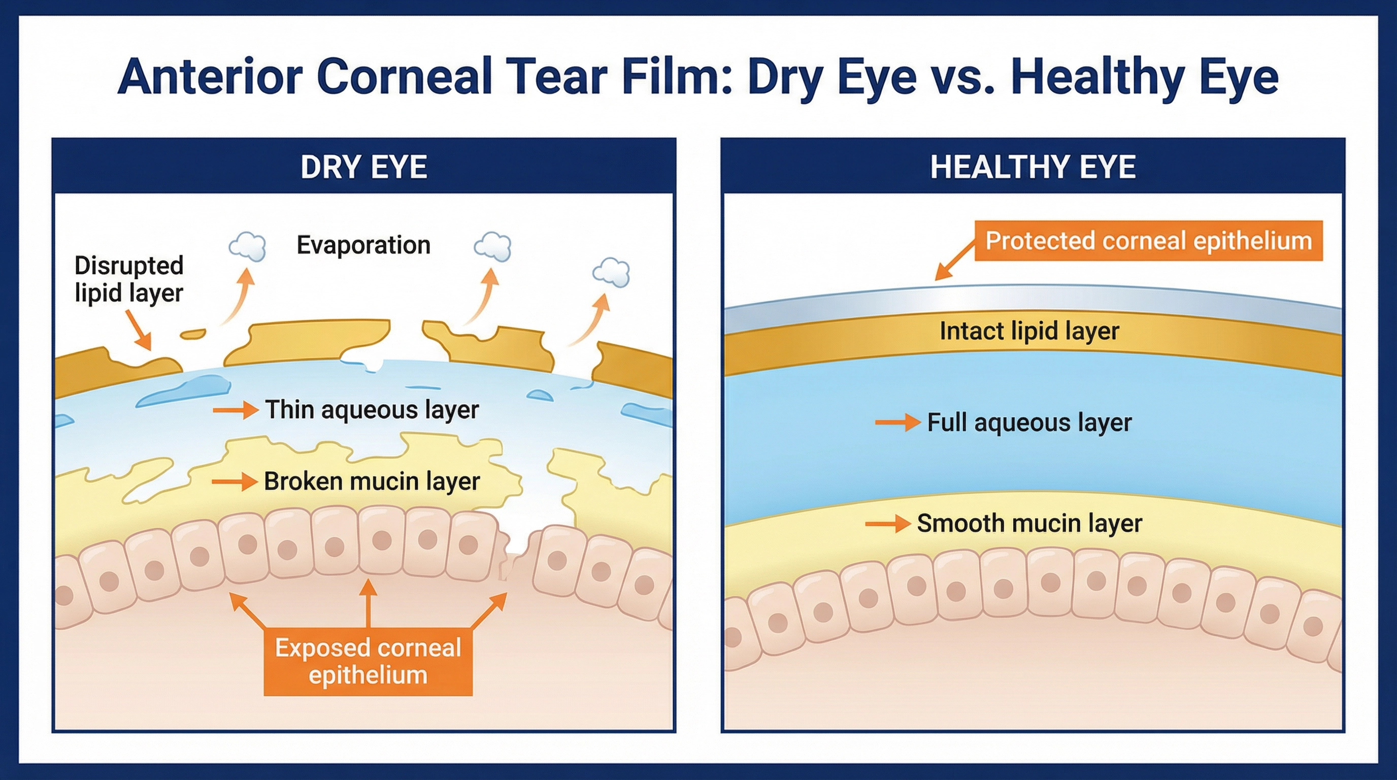 Anterior corneal tear film comparison: dry eye with broken tear film layers vs healthy eye with intact tear film layers
