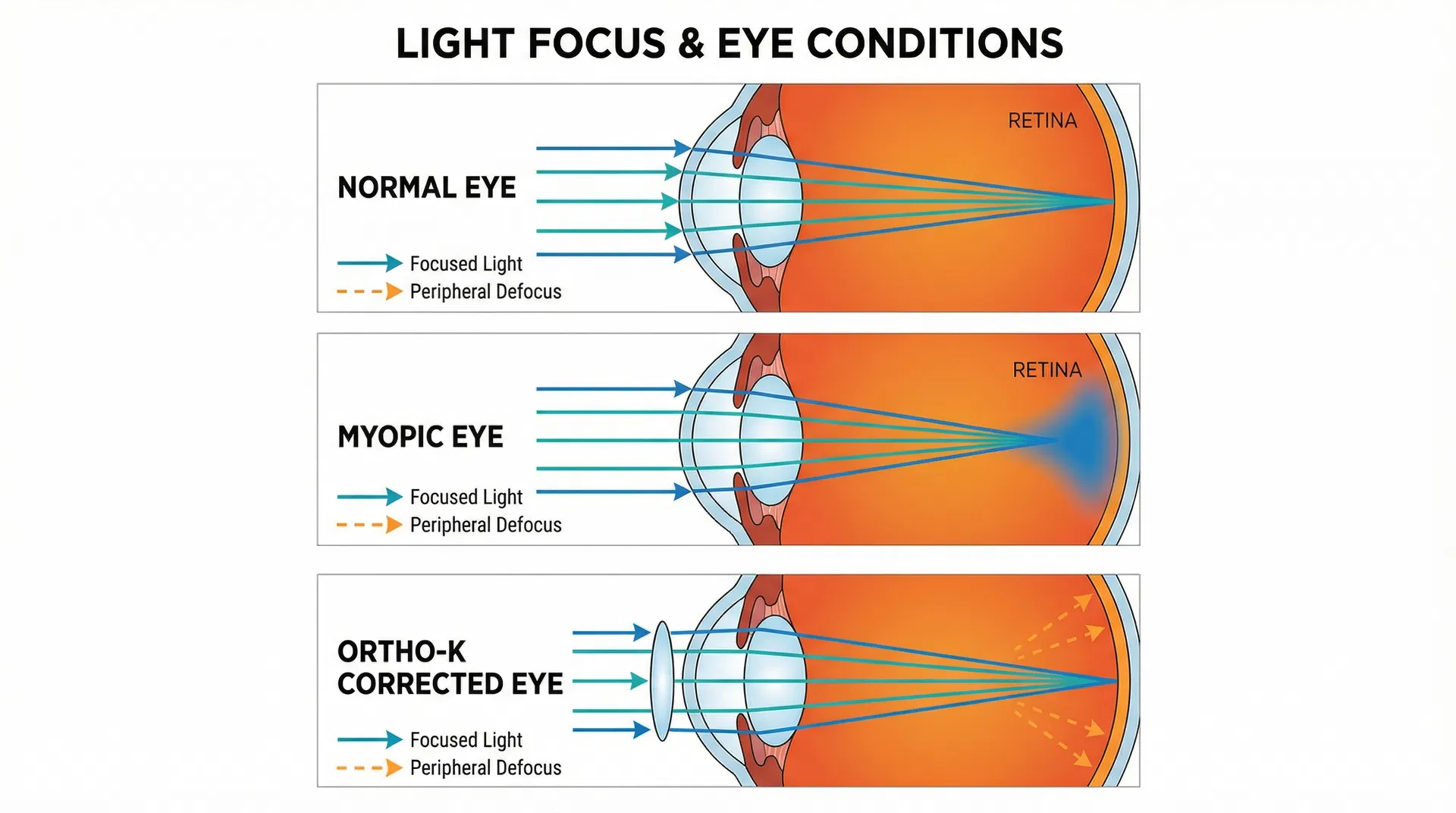 Understanding Peripheral Defocus: Why Ortho-K Works Better Than Glasses for Myopia Control
